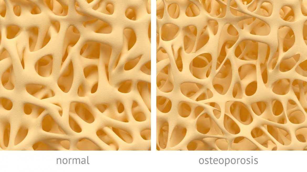 Detalle del interior de un hueso sano y otro con osteoporosis